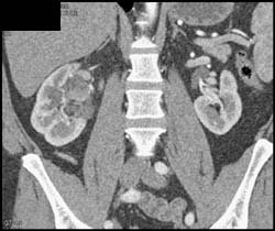 Transitional Cell Cancer (TCC) of Right Kidney - CTisus CT Scan