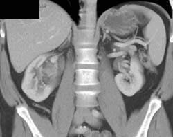 Transitional Cell Cancer (TCC) of Right Kidney - CTisus CT Scan