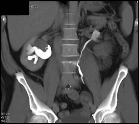 Transitional Cell Cancer (TCC) of Right Kidney - CTisus CT Scan