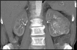 Hypervascular Renal Cell Carcinoma (RCC) - CTisus CT Scan