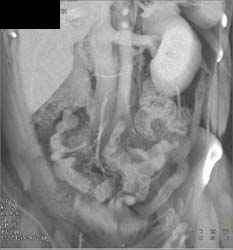 Multiple Right Renal Arteries and Prehilar Branching - CTisus CT Scan