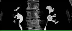 Stent in Renal Pelvis - CTisus CT Scan