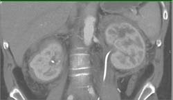 Retroperitoneal Fibrosis-classic Kidneys - CTisus CT Scan