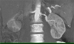 Left Renal Artery Aneurysm - CTisus CT Scan