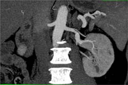 Left Renal Artery Aneurysm - CTisus CT Scan