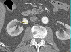 Right Renal Artery Aneurysm - CTisus CT Scan