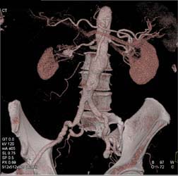 Right Renal Artery Aneurysm - CTisus CT Scan