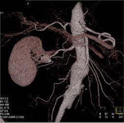 Right Renal Artery Aneurysm - CTisus CT Scan