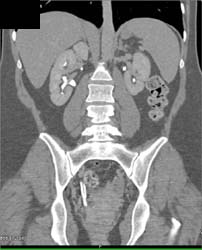 Duplicated Collecting System on the Right-easy to See on CT Urogram - CTisus CT Scan