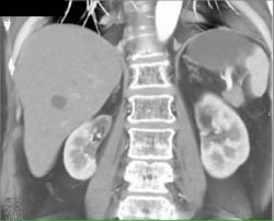 Renal Infarct Due to Radiation Port for Pancreatic Cancer - CTisus CT Scan