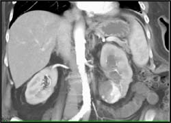 Residual Renal Carcinoma S/P Radiofrequency Ablation (RFA) - CTisus CT Scan