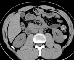 High Density Renal Cyst - CTisus CT Scan