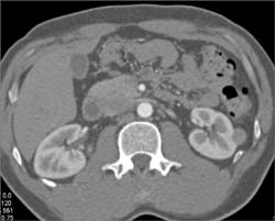 High Density Renal Cyst - CTisus CT Scan