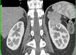 Renal Cell Carcinoma - CTisus CT Scan