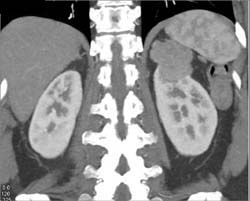 Renal Cell Carcinoma - CTisus CT Scan