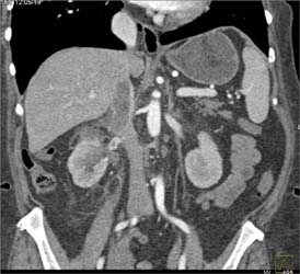 Renal Cell Carcinoma Invades the Inferior Vena Cava (IVC) - CTisus CT Scan