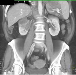 Renal Cell Carcinoma Invades the Inferior Vena Cava (IVC) - CTisus CT Scan