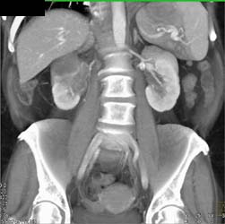 Renal Cell Carcinoma Invades the Inferior Vena Cava (IVC) - CTisus CT Scan