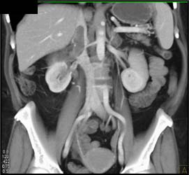 Renal Cell Carcinoma Invades the Inferior Vena Cava (IVC) - CTisus CT Scan