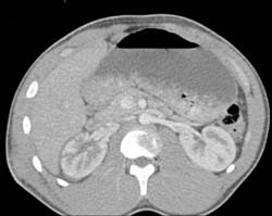 Renal Laceration - CTisus CT Scan