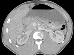 Renal Laceration - CTisus CT Scan