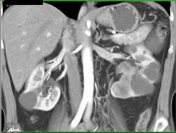 Renal Cell Carcinoma - CTisus CT Scan