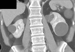 Renal Cell Carcinoma - CTisus CT Scan