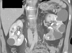 Renal Cell Carcinoma - CTisus CT Scan