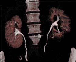 Renal Cell Carcinoma - CTisus CT Scan