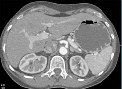 Transitional Cell Cancer (TCC) in Upper Pole of Right Kidney-subtle on Early Phase - CTisus CT Scan