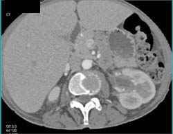 Left Transitional Cell Cancer (TCC) - CTisus CT Scan