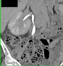 Transitional Cell Cancer (TCC) Right Kidney - CTisus CT Scan