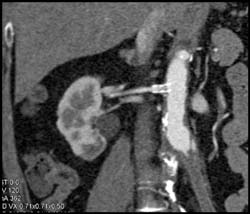 Patent Stent With Minimal Thrombus in Stent - CTisus CT Scan