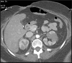 Bilateral Renal Infarcts - CTisus CT Scan