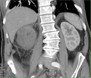 Renal Cell Carcinoma Invades the Inferior Vena Cava (IVC) - CTisus CT Scan