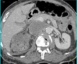 Renal Cell Carcinoma Invades the Inferior Vena Cava (IVC) - CTisus CT Scan