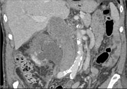 Renal Cell Carcinoma Invades the Inferior Vena Cava (IVC) - CTisus CT Scan