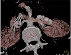 Fibromuscular Dysplasia (FMD) of the Left Renal Artery - CTisus CT Scan