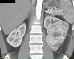 Hypervascular Renal Cell Carcinoma - CTisus CT Scan