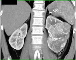 Hypervascular Renal Cell Carcinoma - CTisus CT Scan