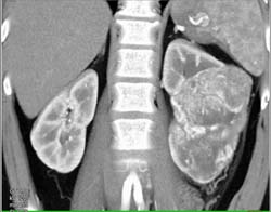 Hypervascular Renal Cell Carcinoma - CTisus CT Scan