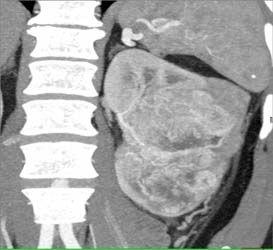 Hypervascular Renal Cell Carcinoma - CTisus CT Scan