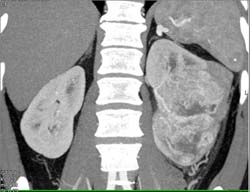 Hypervascular Renal Cell Carcinoma - CTisus CT Scan