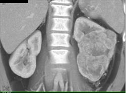 Hypervascular Renal Cell Carcinoma - CTisus CT Scan