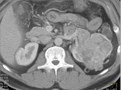 Hypervascular Renal Cell Carcinoma - CTisus CT Scan