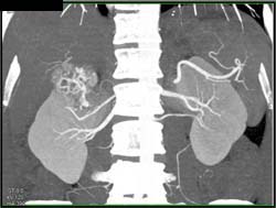 Vascular Renal Cell Carcinoma in Right Kidney - CTisus CT Scan