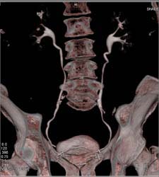 Normal CT Urogram - CTisus CT Scan