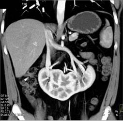 Horseshoe Kidney - CTisus CT Scan