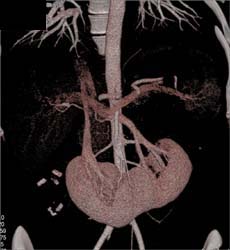 Horseshoe Kidney - CTisus CT Scan