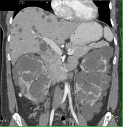 Pck and Pcld - CTisus CT Scan